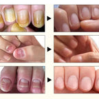 Nail Fungus Treatment Serum Toe Nail Fungus Removal Essence Anti Infection Paronychia Onychomycosis Hand Foot Nail Care Cream