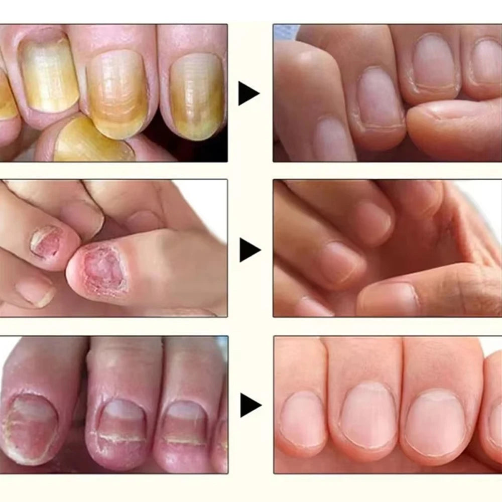 Nail Fungus Treatment Serum Toe Nail Fungus Removal Essence Anti Infection Paronychia Onychomycosis Hand Foot Nail Care Cream