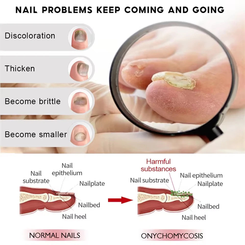 Nail Fungus Treatment Serum Toe Nail Fungus Removal Essence Anti Infection Paronychia Onychomycosis Hand Foot Nail Care Cream